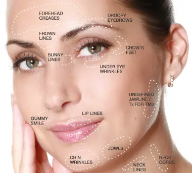A female face showing botox areas